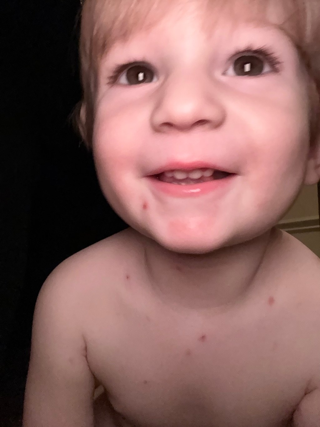 Pox Parties Explained: Risks vs. Benefits for&nbsp;Kids