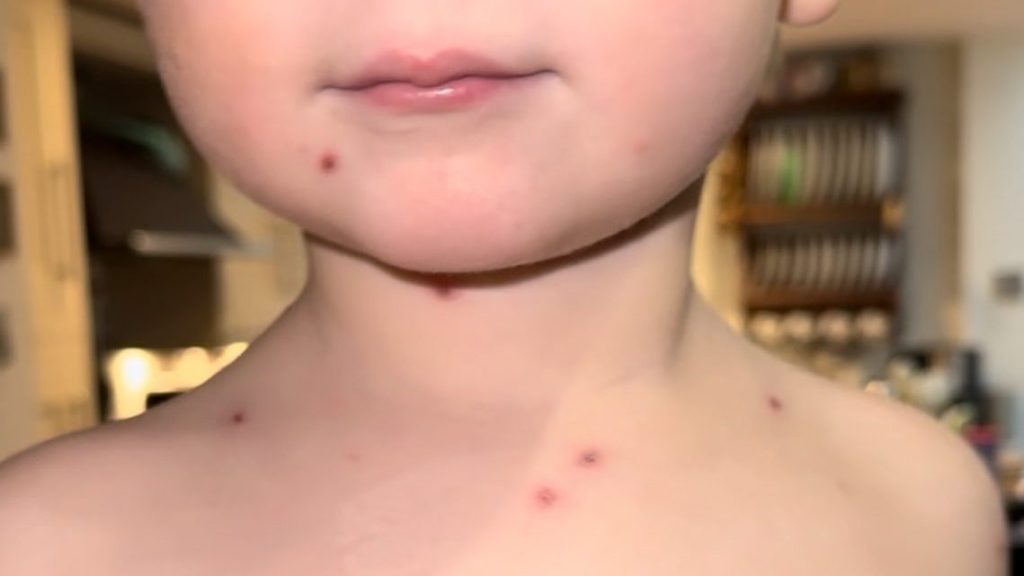 Chicken Pox Vaccine Rollout in the UK: Why Has It Taken So&nbsp;Long?
