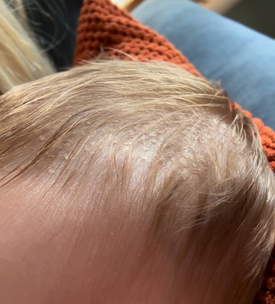 cradle cap or sebhorrheic dermatits appearing as fine greasy flakes on a baby's scalp