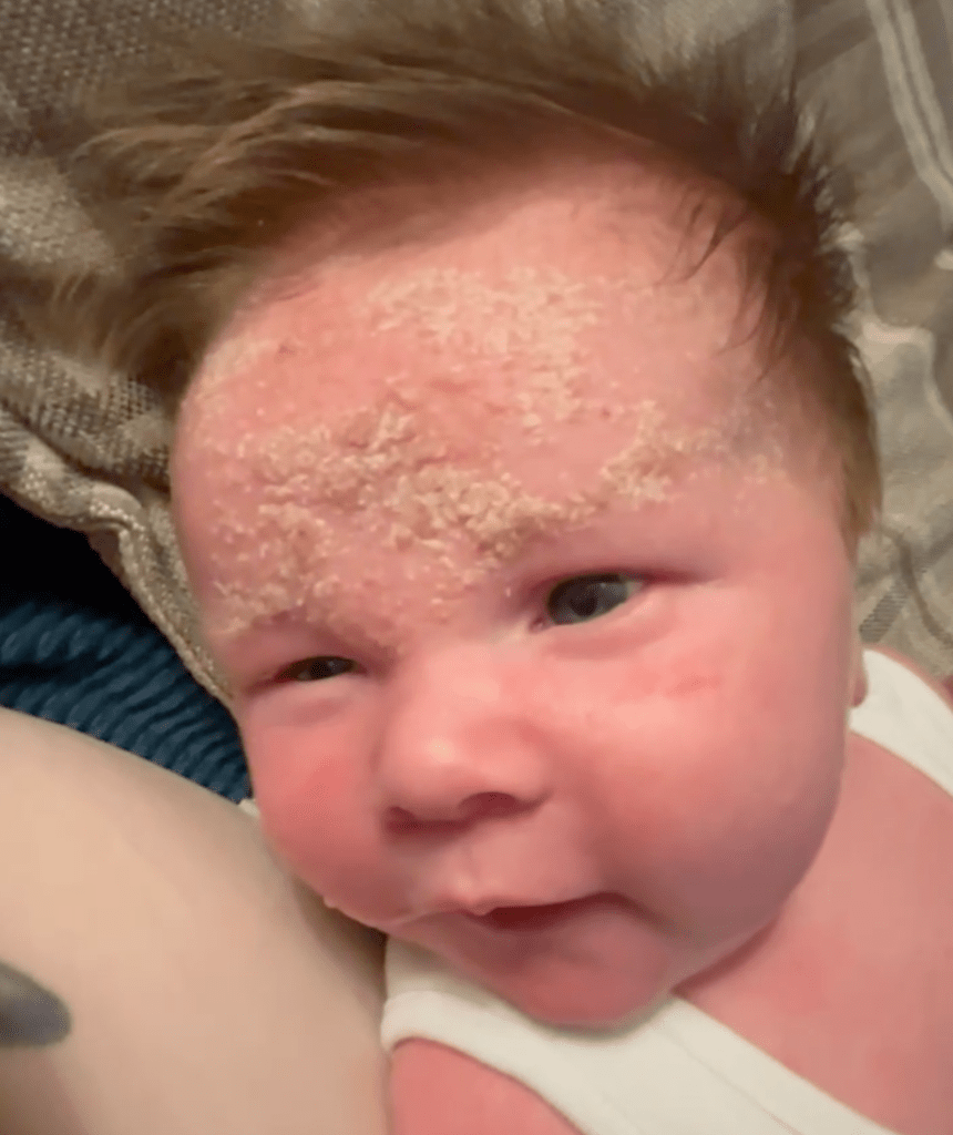 cradle cap or sebhorrheic dermatits appearing as a yellow greasy flakes on a baby's forehead and eyebrows